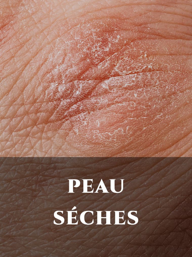 PEAU SÉCHE