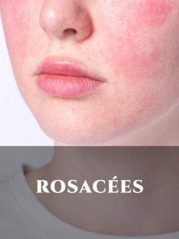 ROSACEES