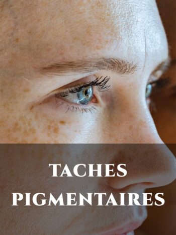 TACHES PIGMENTAIRES