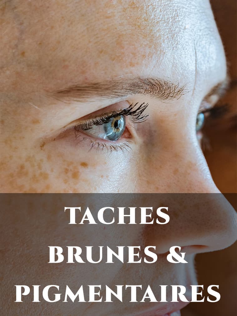 TACHES BRUNES & PIGMENTAIRES